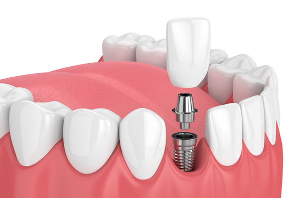 Rendering of jaw with dental implant New York, NY