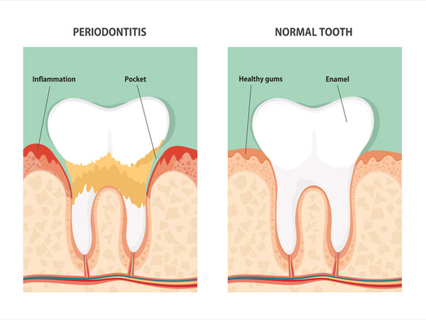 Diagram of periodontitis and health tooth in New York, NY