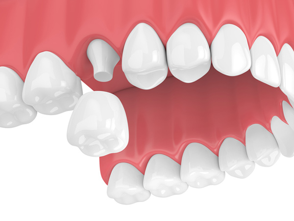 Rendering of jaw with dental crown in New York, NY