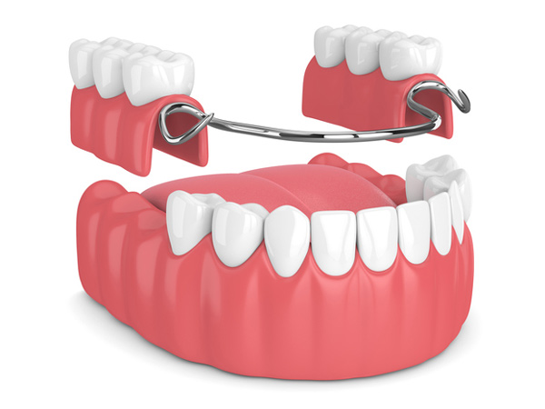 Rendering of removable partial denture in New York, NY