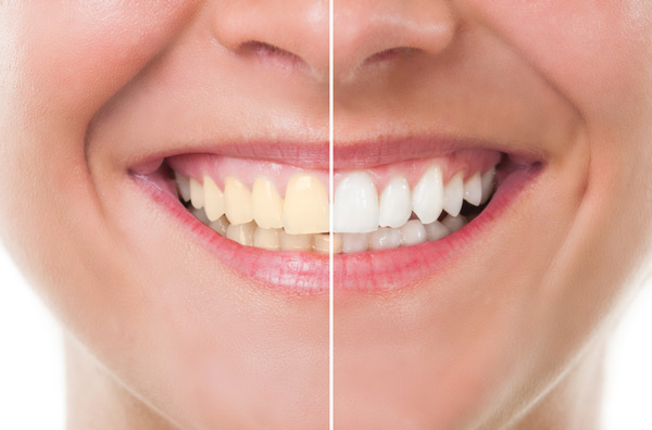 Before and after photo of teeth whitening treatment in New York, NY
